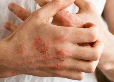 جدیدترین درمان برای اگزما؛ مالیدن باکتری به پوست